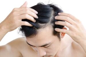 Alopécie et pelade - Centre Magenta Nice